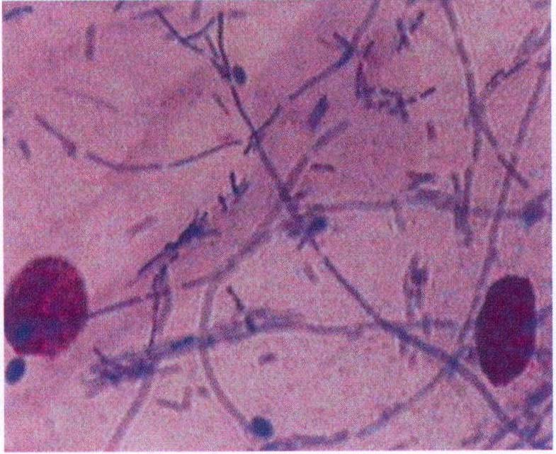 图4-40 霉菌、细菌混合感染